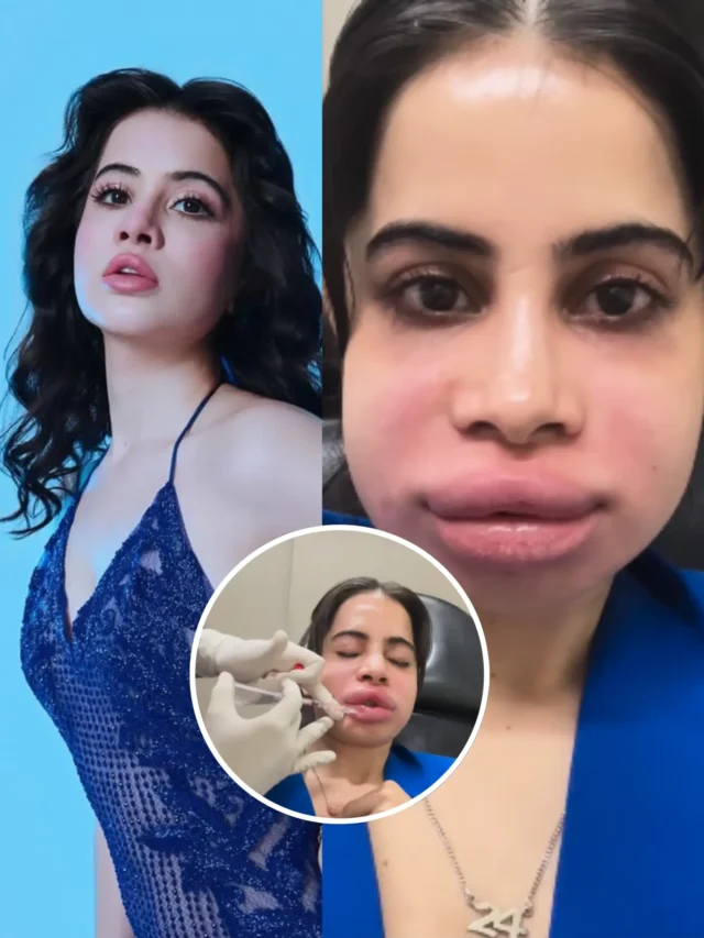 Uorfi Javed Swollen Face Goes Viral After Lip Filler Removal!